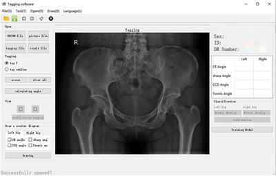 Computer-Aided System Application Value for Assessing Hip Development